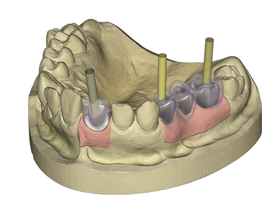 EXOD/FM/IMPLANT